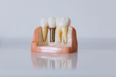 Does Medicaid Cover Dental Implants? Rules & Eligibility