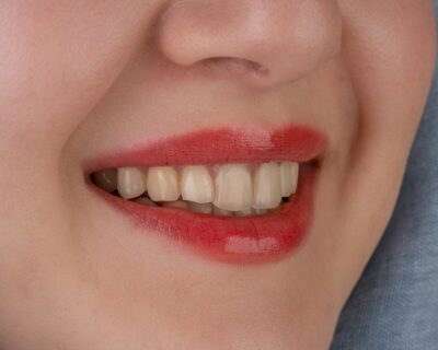 does medicaid cover veneers