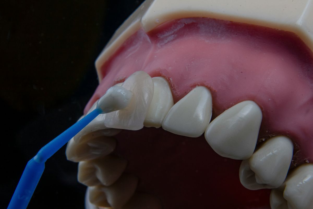 does-medical-cover-veneers-featured